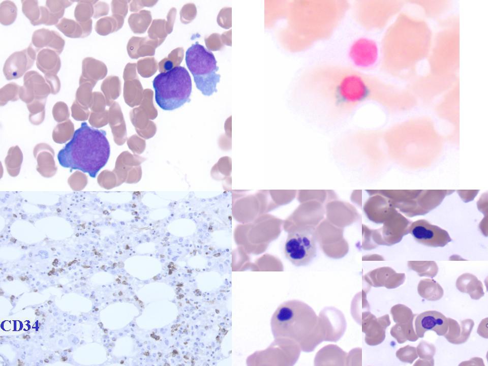 Clockwise from upper left: Increased blasts on aspirate smear, Ring sideroblast (iron stain), Significant erythroid dysplasia on aspirate smears and CD34 on core biopsy showing increased blasts.